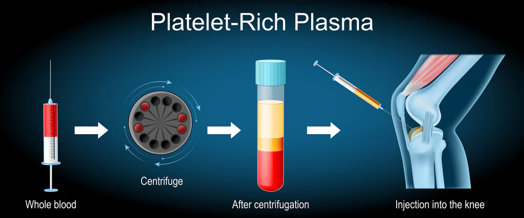 Knee Pain Got You Down? Discover How PRP Therapy in Lecheng Uses Your Own Blood to Heal 10 Platelet Rich Plasma PRP