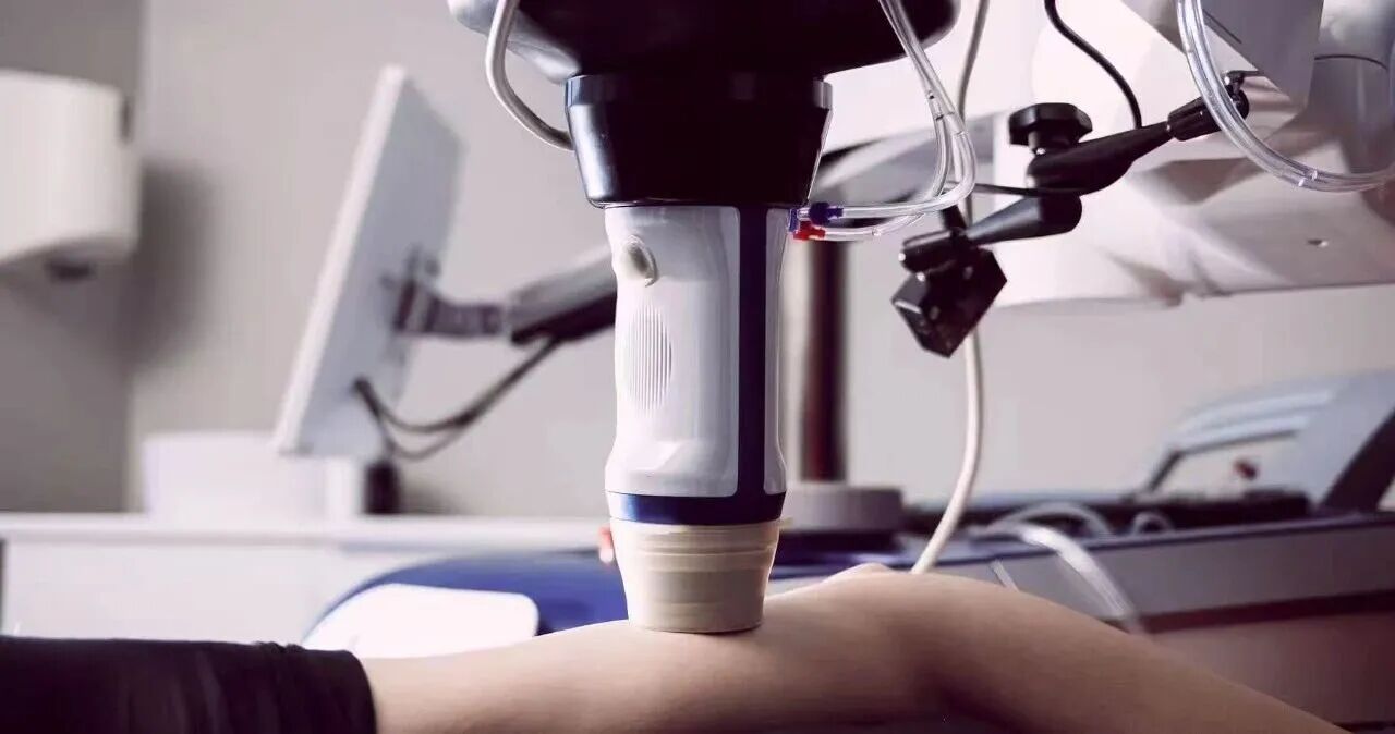 SONOVEIN HIFU: Non-Invasive Varicose Vein Cure – Now at Lecheng